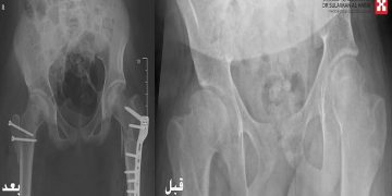 إنجاز طبي بمستشفى الدكتور سليمان الحبيب بالخبر يعيد القدرة على المشي لشاب بعد معاناة 10 سنوات