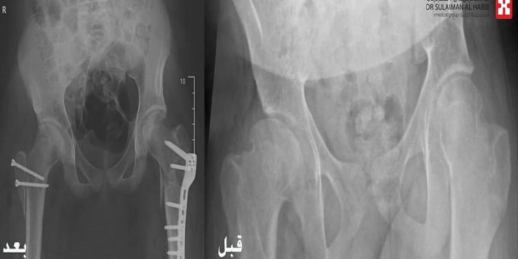 إنجاز طبي بمستشفى الدكتور سليمان الحبيب بالخبر يعيد القدرة على المشي لشاب بعد معاناة 10 سنوات