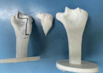 إنجاز طبي سعودي