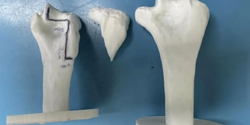 إنجاز طبي سعودي