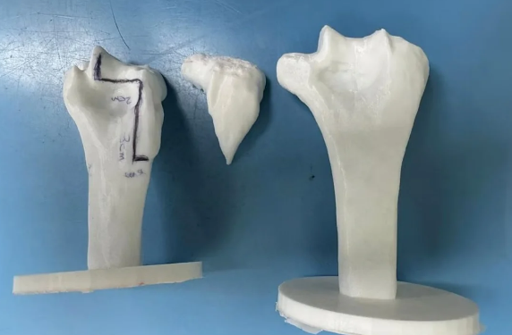 إنجاز طبي سعودي