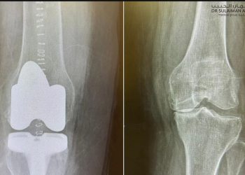 نجاح عملية دقيقة