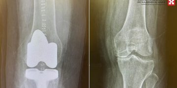 نجاح عملية دقيقة