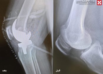 مستشفى الدكتور سليمان الحبيب ينجح في إجراء عملية دقيقة لاستبدال مفصلي الركبة لسيدة سبعينية