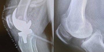 مستشفى الدكتور سليمان الحبيب ينجح في إجراء عملية دقيقة لاستبدال مفصلي الركبة لسيدة سبعينية