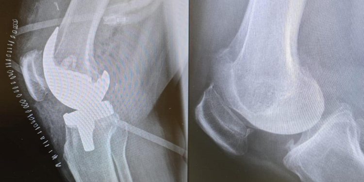 مستشفى الدكتور سليمان الحبيب ينجح في إجراء عملية دقيقة لاستبدال مفصلي الركبة لسيدة سبعينية