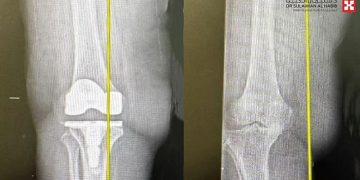 استبدال مفصل