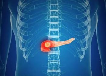 سرطان البنكرياس