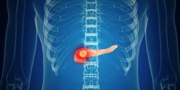 سرطان البنكرياس