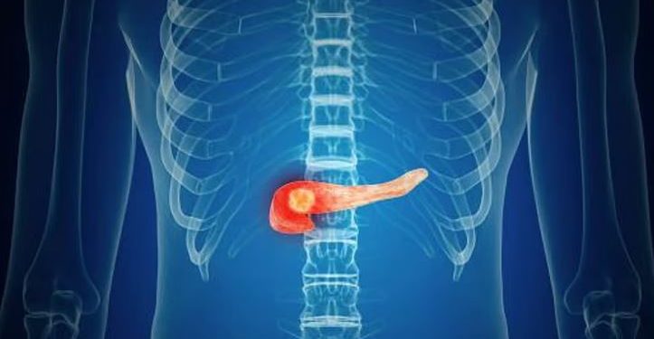 سرطان البنكرياس