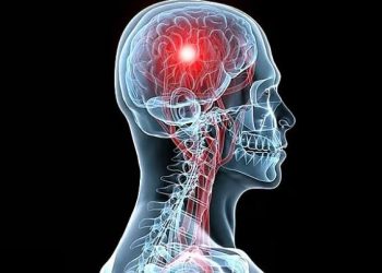 السكتة الدماغية