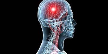 السكتة الدماغية