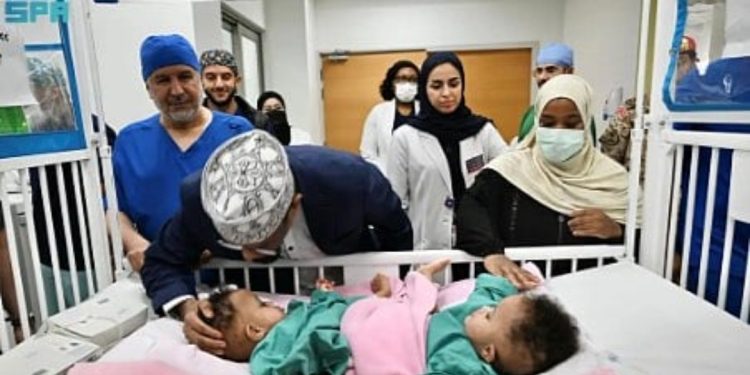 فريق طبي سعودي يبدأ عملية معقدة لفصل التوأم السيامي “رحمة ورملا” في الرياض