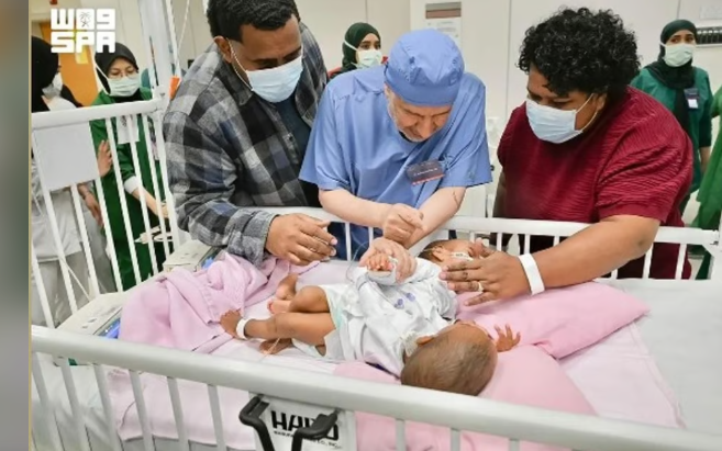 عملية فصل التوأم الملتصق الفيجي
